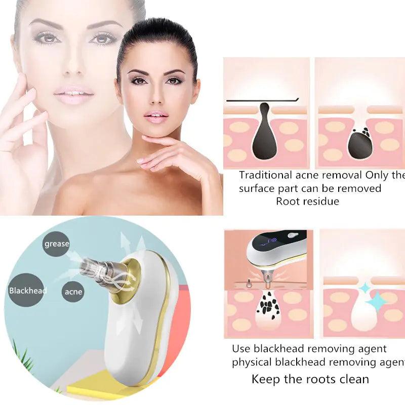 Vacuum Suction Beauty Machine - Deep Cleansing - Sí Fashions