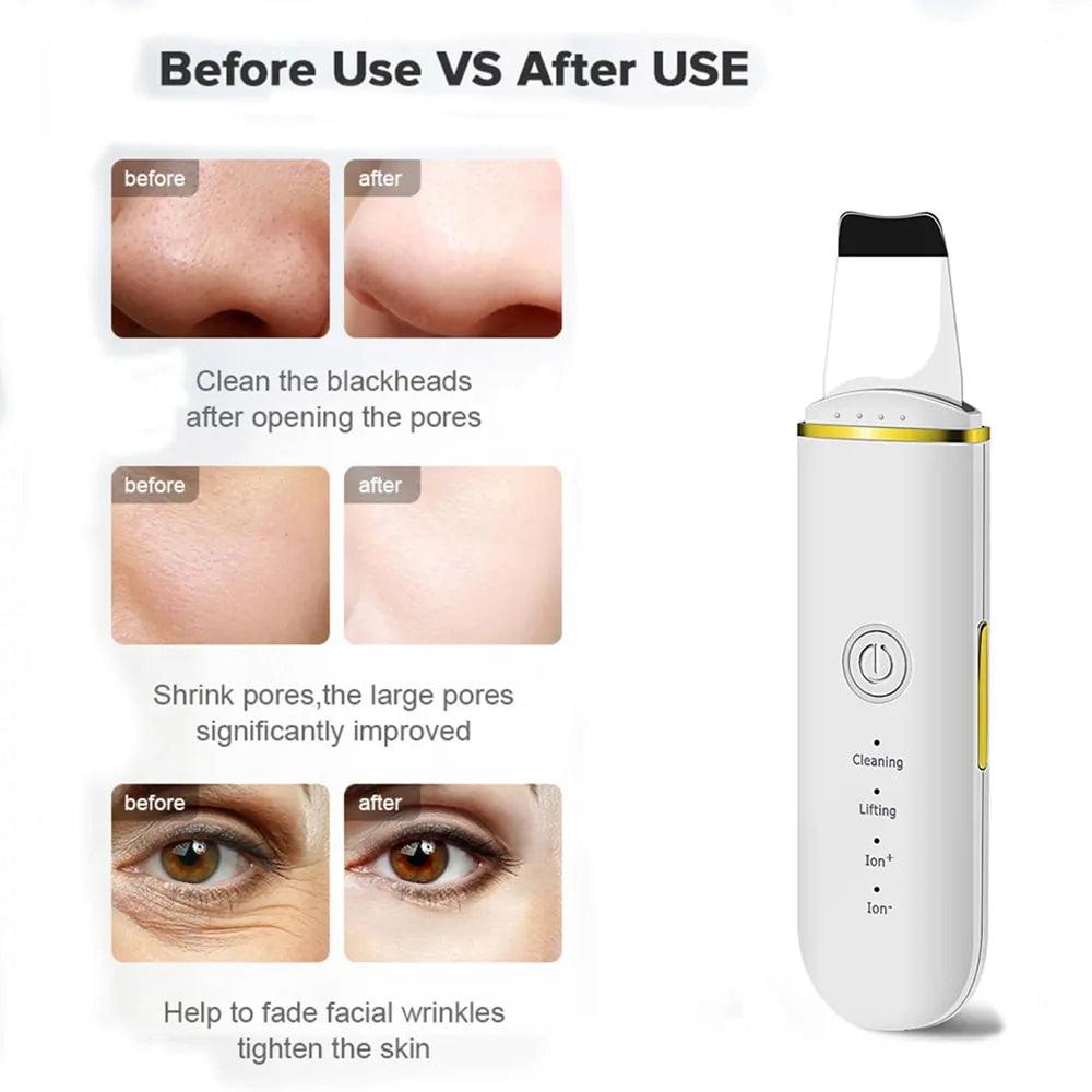 Beauty Ultrasonic Skin Scrubber - Sí Fashions