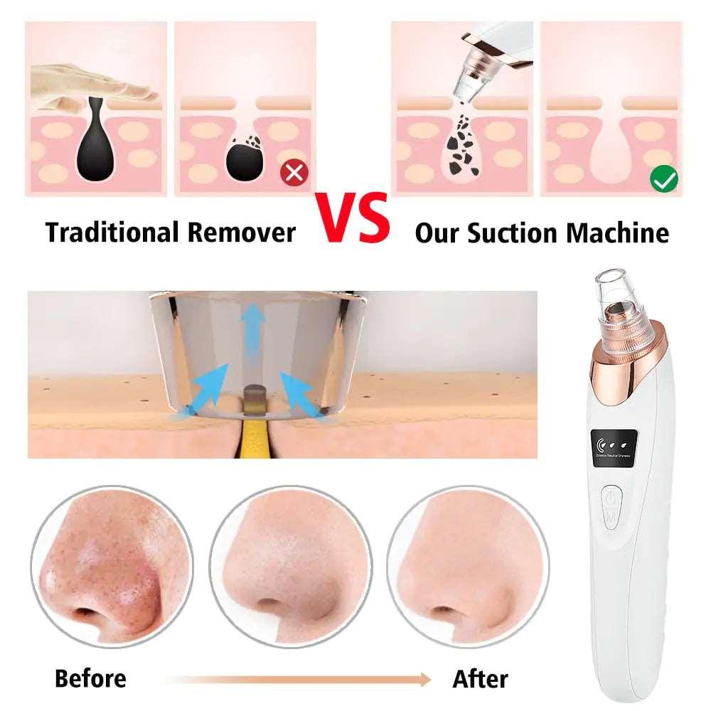 Beauty Electric Blackhead Remover - Sí Fashions